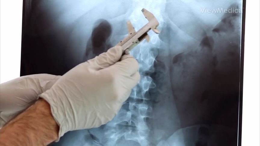 Fractura Vertebral Osteoporótica Compresión